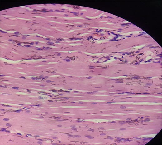 Haematoxylin and eosin stained section showing skeletal muscle fibres with chronic inflammatory infiltrate.