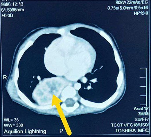 Axial view CT scan shows right intrathoracic kidney (arrow).