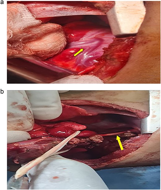 (a) Shows the sequestration feeding artery (arrow). (b) Shows the dissected feeding artery traversing the right hemidiaphragm originating from the abdominal aorta.