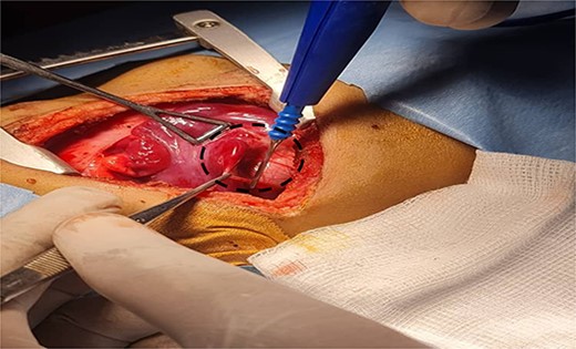 Shows the sequestrated lung lobe dissected off the fascia of gerota (shown by interrupted line).