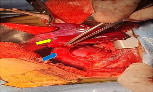 Shows dissection of the sequestration (yellow arrow) and ectopic kidney after separation from fascia of gerota (can see the renal capsule) (blue arrow).