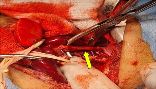 Shows the dissected feeding artery.