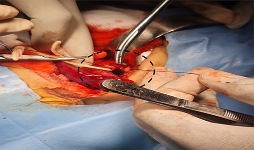 Illustrates ligation of feeding artery.