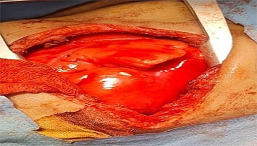 Shows inflation of the previously hyperemic sequestrated lung lobe after ligation of the feeding vessel.