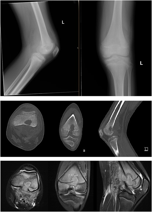 Preoperative radiography, CT, and MRI. The radiographs were read as normal by the radiology, while the CT and MRI were read osteomyelitis with Brodie’s abscess involving the distal femoral epimetaphysis with destruction of the posterior cortex and associated 7 cm popliteal fossa abscess, along with a suspected nonocclusive septic thrombophlebitis of the popliteal vein mentioned in the report on the CT.