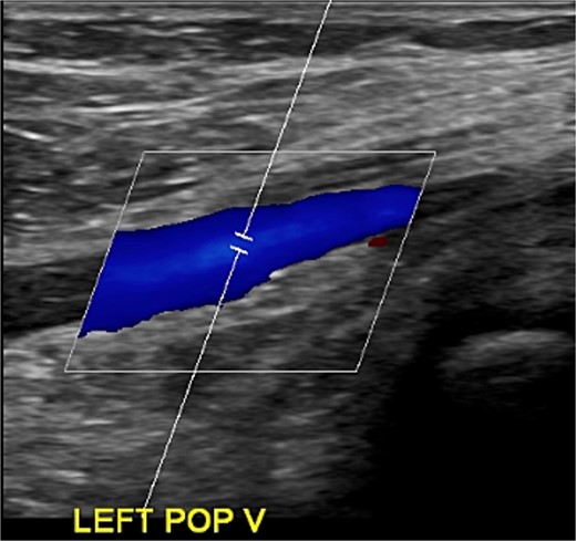 Ultrasonography obtained in January of 2023 demonstrating resolution of DVT.