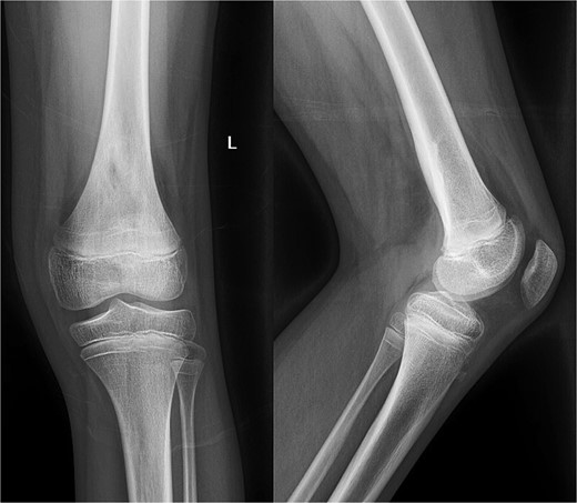 Radiography obtained 1-year postoperatively, demonstrating no acute osseous changes.