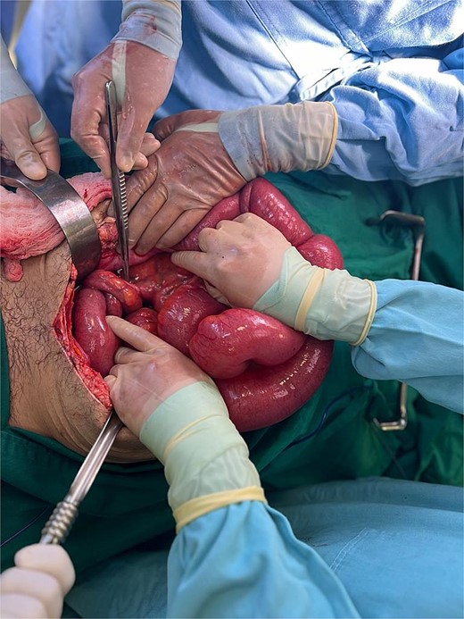Parastomal hernia and small bowel obstruction after loop ileostomy.