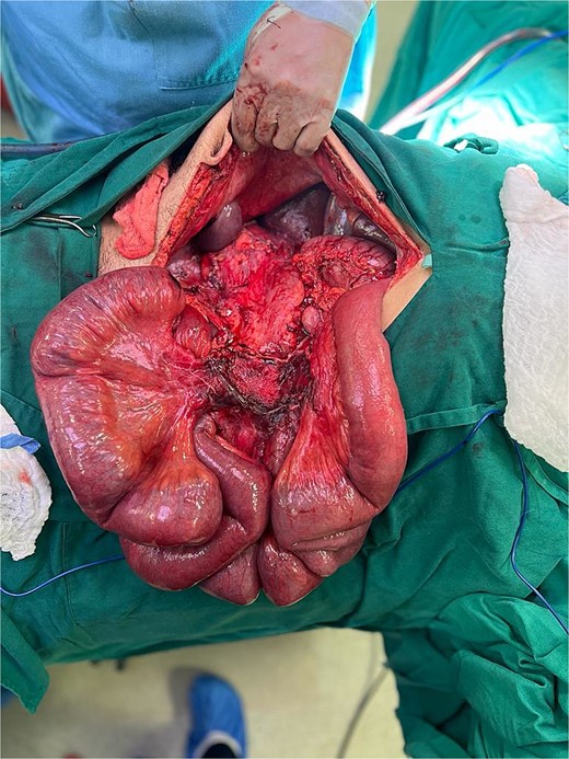 Nodular mass (~20 × 15 cm) in the mesentery of the ascending colon.