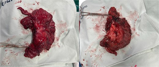 Biopsy sent to pathology.