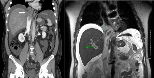 Primary IVC synovial sarcoma extending from the retrohepatic cava into the right atrium. Left: coronal slice of abdominal CT scan with IV contrast showing occlusive intravascular lesion (white arrow). Right: coronal abdominal MRI T2 slice demonstrating 5.8 cm enhancing intravascular lesion.