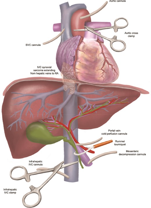 Cannulation scheme during ante situm liver perfusion.