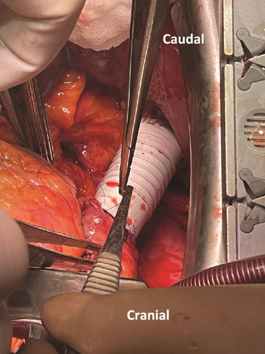 Intraoperative reconstruction of IVC with PTFE graft.