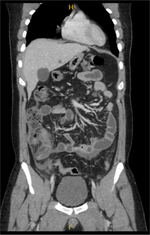 Coronal view of the inflamed appendix with phlegm formation.