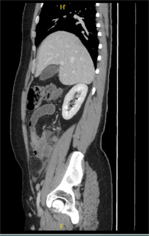Sagittal view of the inflamed appendix with phlegm formation.