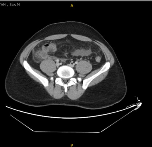 Axial view of the inflamed appendix with phlegm formation.