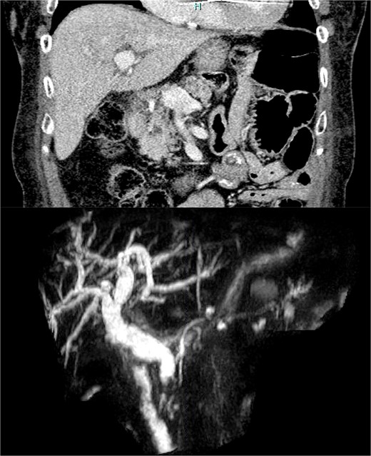 (a) CT scan image of the cystic lesion within the head of the pancreas. (b) MRCP image of intrahepatic and extrahepatic bile duct dilation with abrupt change in caliber at the distal CBD.
