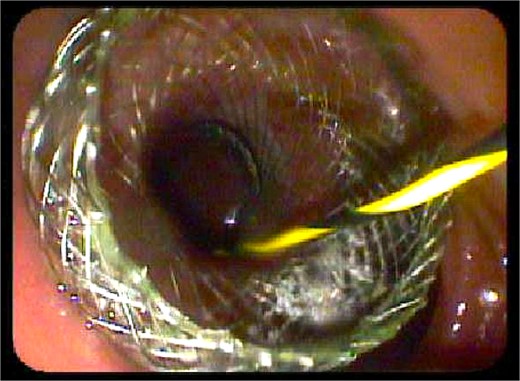 Endoscopic view of the Axios stent during preoperative EDGE procedure.