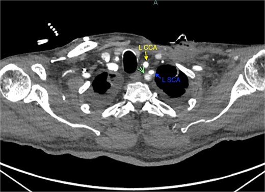 Demonstration of pseudoaneurysm of the proximal left subclavian artery on axial image (green arrow: L SCA PSA, blue arrow: left subclavian artery, yellow arrow: left common carotid artery).