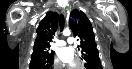 Demonstration of pseudoaneurysm of the proximal left subclavian artery on axial image (green arrow: L SCA PSA, blue arrow: left subclavian artery).