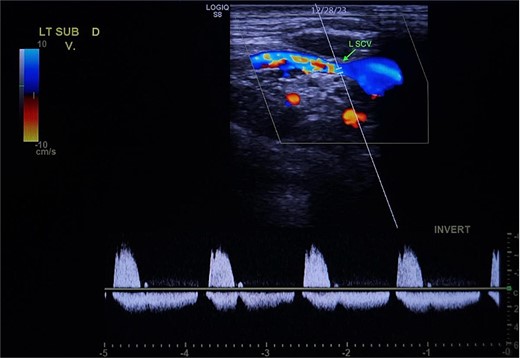 Demonstration of arterial waveform in the left subclavian vein on Duplex ultrasound (green arrow: left subclavian vein).