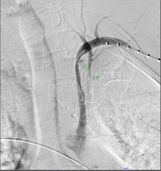 Demonstration of fistulous connection between subclavian artery and vein (green arrow).