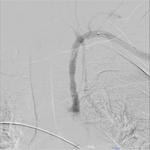 Demonstration of covered stent placement and resolution of the fistulous connection.