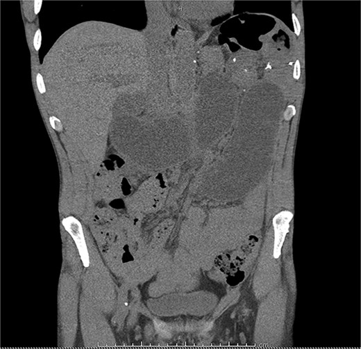 A CT scan of the patient’s abdomen demonstrating obstruction suggestive of internal hernia.