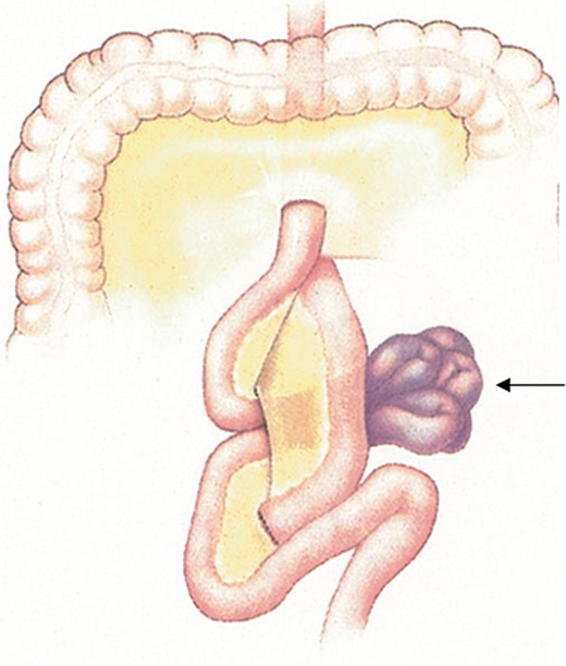 A conceptualization of an internal hernia after Roux-en-Y reconstruction. Permission obtained from Peter M. van Brussel, MD, PhD.