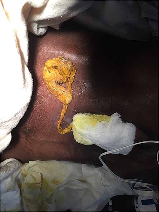 A picture of what remained of the patient’s cecum, completely detached from the small bowel.
