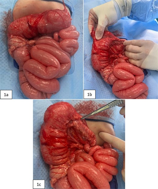 Intraoperative pictures taken prior to extended right hemicolectomy. Figure 1(a) shows the ascending colon and dilated transverse colon, along with diffuse enlargement of small bowel. Figure 1(b) demonstrates the difference in diameters of the proximal versus distal transverse colon. Figure 1(c) highlights the thickened, narrowed lumen of the distal transverse colon.