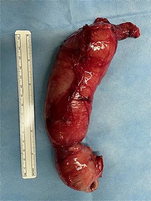 Postoperative image taken of the resected bowel. The south end contains the proximal large bowel (ileocecal valve and the cecum), and the distal portion shows the terminal end of the atretic transverse colon.