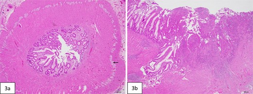 Histopathologic evaluation of the resected bowel. (a) Cross-section of stenotic colon shows severely narrowed lumen. Ganglion cells are present in Auerbach plexus (arrow). (b) Mucosal ulceration (right side of figure) in the adjacent colon proximal to the stenosis.