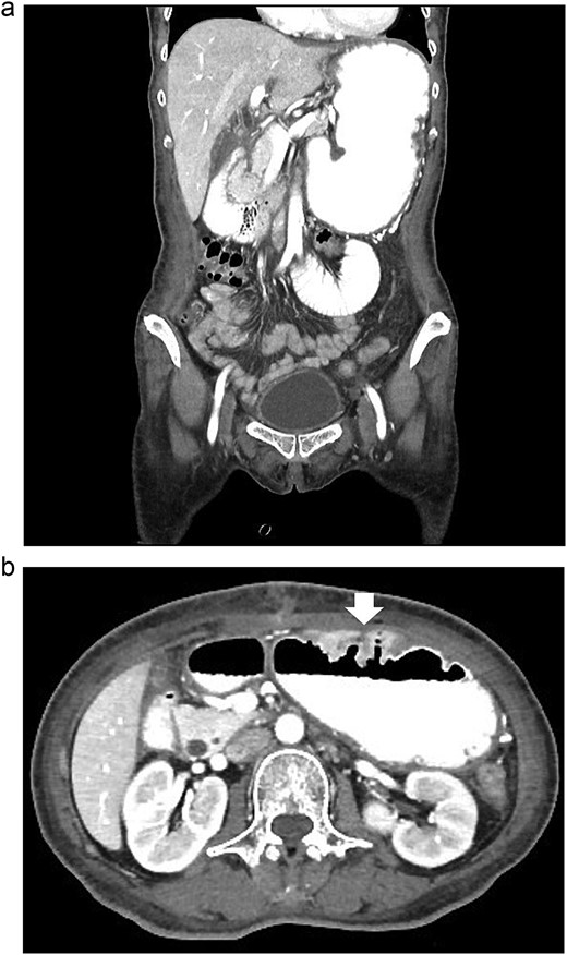 The CT scan of abdomen: (a) coronal view showed dilated stomach and afferent limb, (b) axial view showed gastrojejunostomy anastomosis angulation and kinking (arrow).