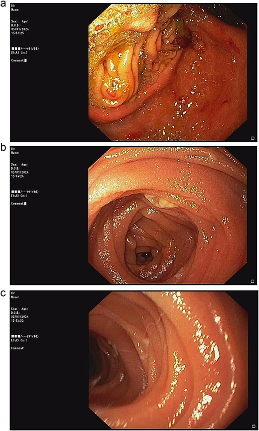 Upper endoscopic findings: (a) patent gastrojejunostomy anastomosis, (b) afferent limb distal to the angulation, (c) efferent limb distal to the angulation.