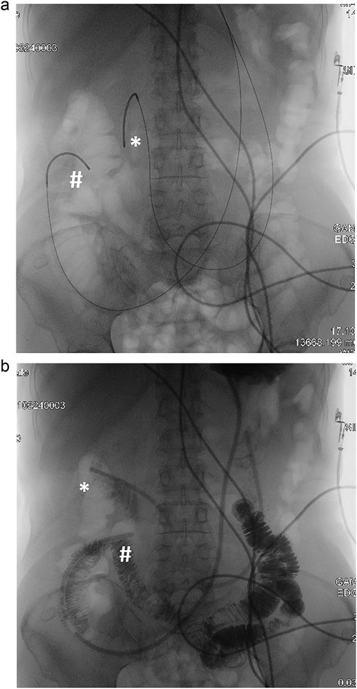 Fluoroscopy and contrast study: (a) Savary-Gilliard guidewires were placed, (b) naso-enteric tubes were placed (*: afferent limb, #: efferent limb).