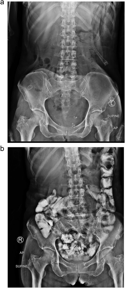 Two weeks of conservative treatment: (a) abdominal plain film, (b) oral contrast study.