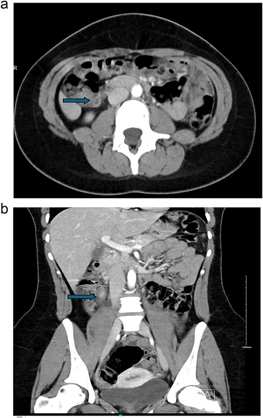 (a) Axial view and (b) coronal view showed a dilated appendix up to 1 cm with mural edema and hyperenhancement surrounded by mild fat stranding, subcentimeter reactive lymph nodes, minimal free fluid, and thickened adjacent peritoneal reflection.