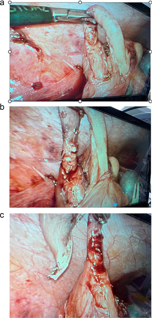 Intra-operative findings of the appendix with two bases connected to the cecum and forming a horseshoe appearance, which is an anomaly of the appendix.