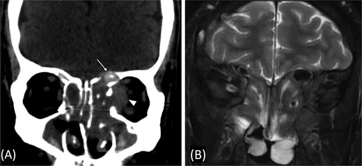 (A) Paranasal sinuses CT scan without contrast showing opacification of the sinuses with hyperdense contents. It results dehiscence of the left lamina papyracea and extension in the medial extraconal space (arrowhead). The ethmoid air cells roof show dehiscence of the roof with intracranial extension (arrow). (B) Coronal T2 MRI through the posterior aspect of left orbit shows the intra-orbital extraconal extension as well as the hypointense left ethmoidal disease with extradural intracranial extension.