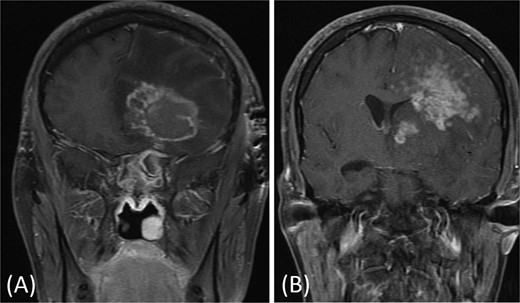 (A and B) Brain MRI with contrast showing signs of intracranial abscess in the left side with mass effect and midline shift to the right side.