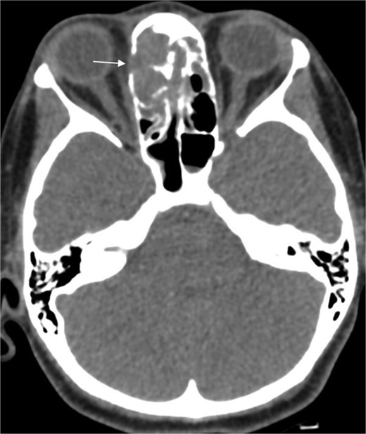 Paranasal CT scan without contrast a mass in the left ethmoid cavity with erosion of the lamina papyracea (arrow).