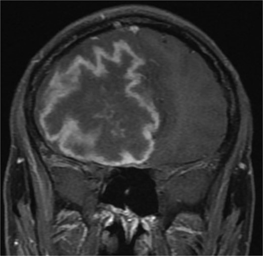 Brain MRI showing right-sided cerebral abscess with midline shift to the left side.