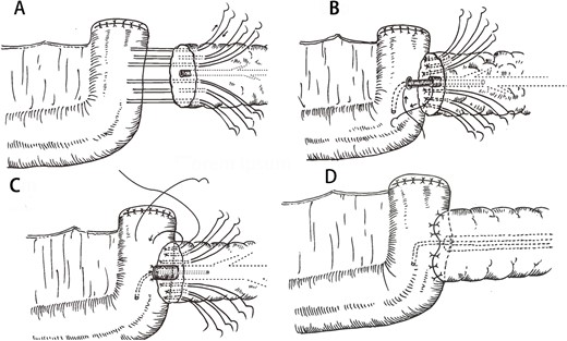 Key process of the double-row and six-suture PJ. (A) Four U-sutures were distributed at the upper and lower margins of the pancreas and the upper and lower of the MPD. Two back-row U-sutures were designed about 1 cm posterior to the midpoints of the two front-row U-suture points of the two sides of the MPD. (B) A support tube was placed in the MPD and four stitches were intermittently sutured between the MPD and the jejunal mucosa. (C) Six U-sutures were again passed through the anterior wall of the jejunum. (D) Finally, the pancreas and jejunum were tied together.