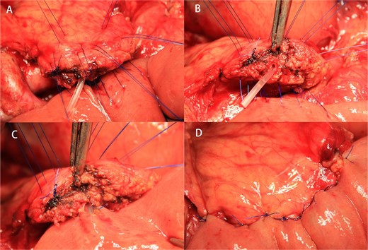 The double-row and six-suture PJ were shown in an operative scene. (A) The layout of double-row and six-suture on the pancreas. (B) An unsecured stent tube was placed in the MPD. (C) Four interrupted sutures were placed between the MPD and the jejunal mucosa under the guidance of the stent tube. (D) Six sutures were tightened after passing through the anterior wall of the jejunum again.