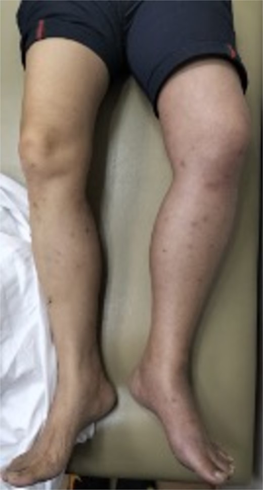 Acute left leg swelling and discoloration.