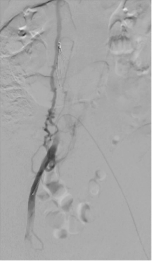 Cross-over right iliac venogram.
