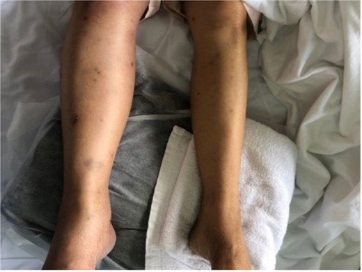 Right lower limb PCD.