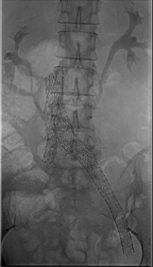 Kissing iliac vein stents.