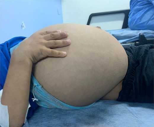 Massive abdominal distention mimicking pseudoascites.